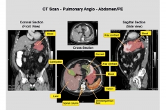 Colorized Abdominal CT Scan