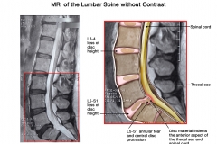 MRI Lumbar Spine