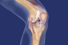 Osteoarthritis of the Knee