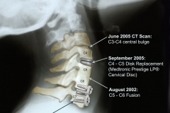 Cervical Fusion